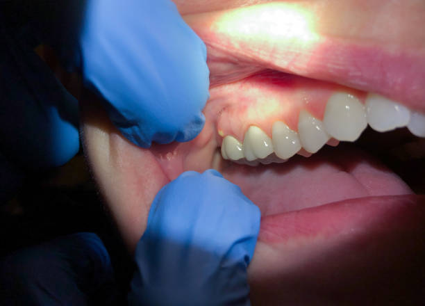 Best Emergency Dental Care for Broken or Chipped Teeth in Hackettstown, NJ